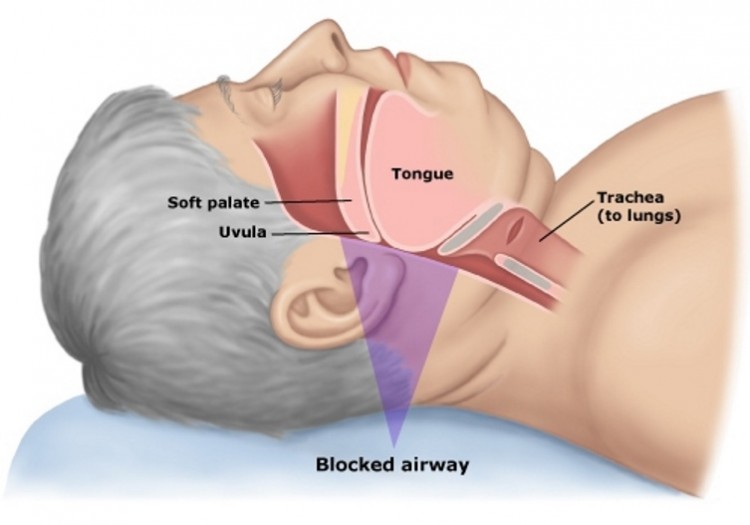 "Estoy cansado y no duermo", “La Apnea del sueño”