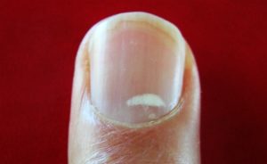 Las manchas blancas en las uñas pueden ser causadas por problemas de salud