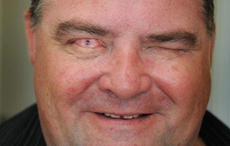 Bunnie Adams y Martin Jones, ciegos que ahora ven por un trasplante de dientes