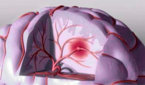 Los ACV primera causa de discapacidad - cómo evitarlo -