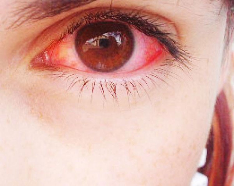 Las Alergias crecen como una Plaga