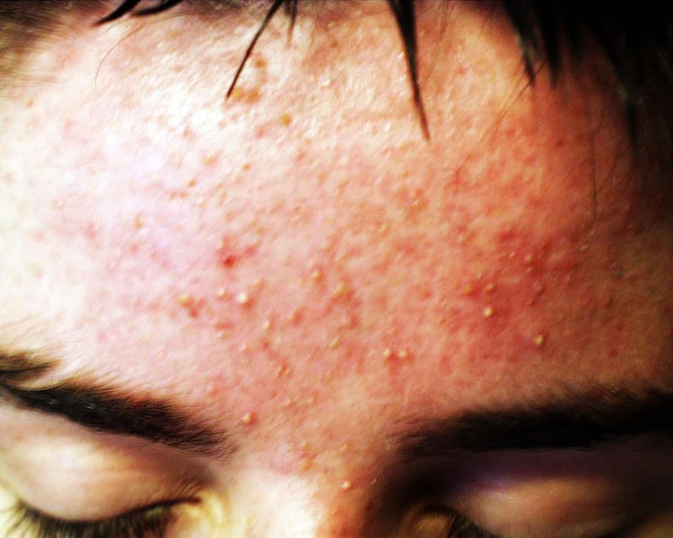 ¿Puede la Alimentación causar acné?