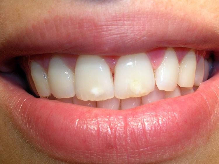 Qué causa Mi mal aliento – Halitosis – Consejos -