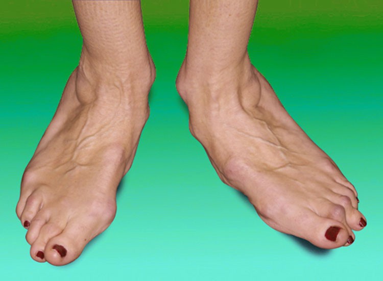 Las botas podrían causar la artritis