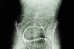 la lombriz solitaria