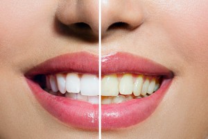 blanquear los dientes