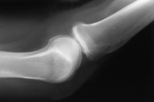 células madres para artritis y lesiones