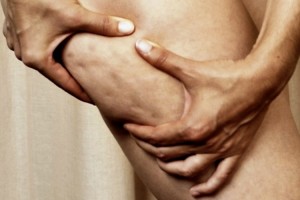 Celulitis? ¿Qué la causa? el Diagnóstico
