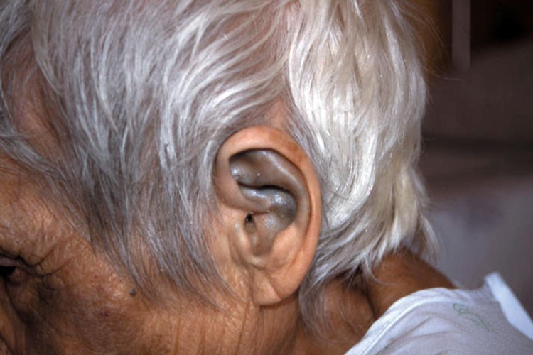 Alcaptonuria, la enfermedad de los huesos negros