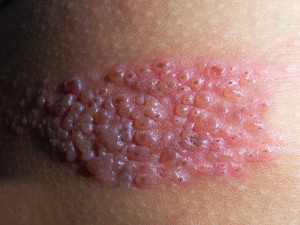 Lo mejor contra la culebrilla