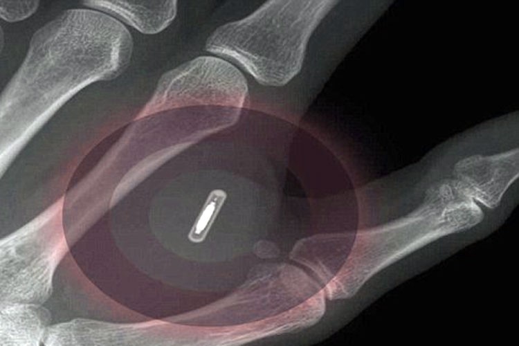 microchip en la mano