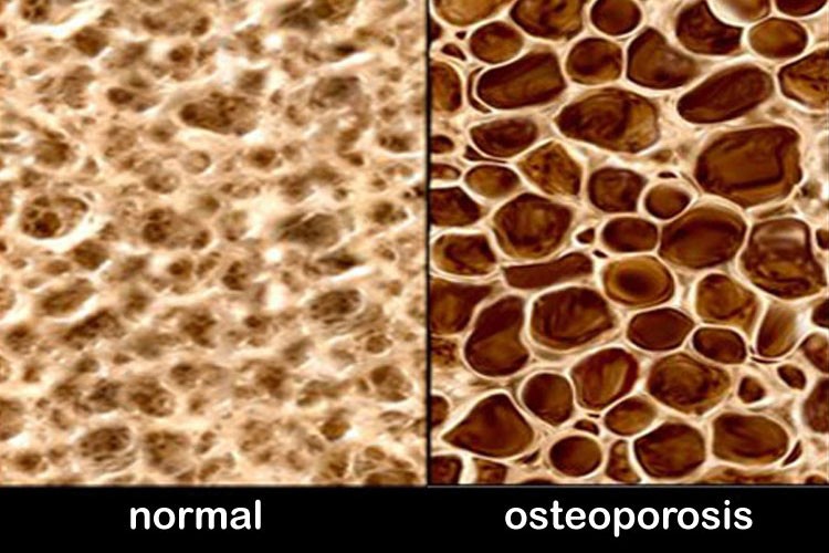 Inyecciones de pasta de hueso para osteoporosis