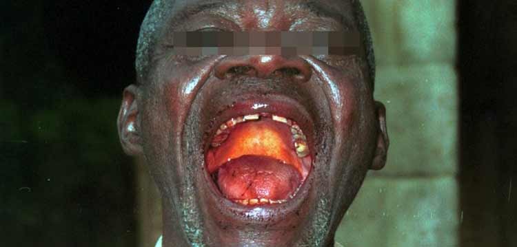 Ébola en pocas palabras