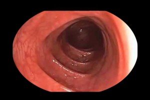 limpieza de colon