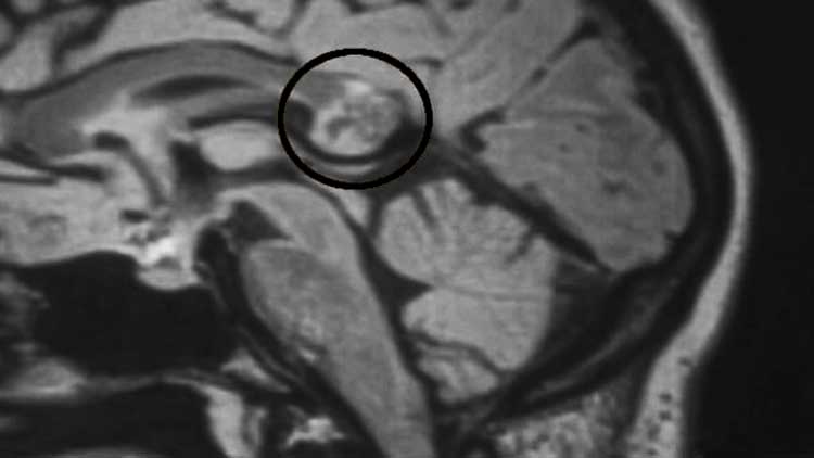 embrión en el Cerebro