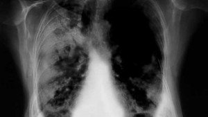 cáncer de pulmón