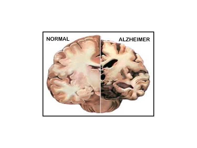 El Alzheimer ¿es contagioso o no?