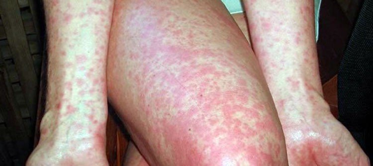 Vuelve una enfermedad común del siglo pasado