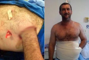 Hombre se ha cosido la mano en el abdomen