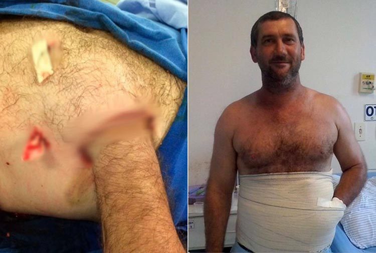 Hombre se ha cosido la mano en el abdomen