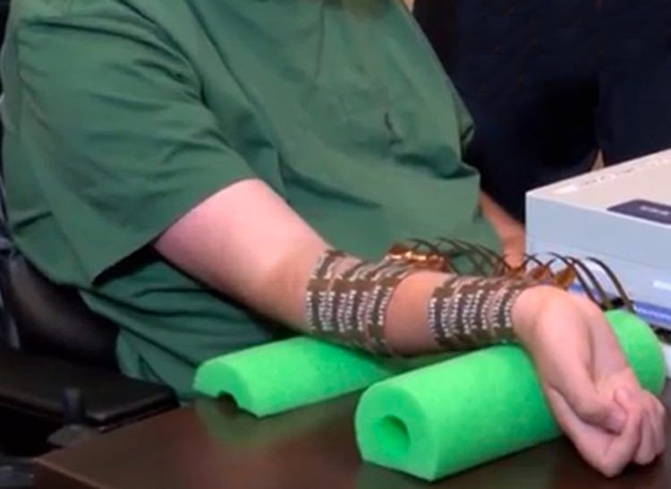 Chip en el cerebro le deja mover su mano