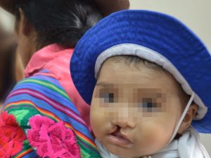 Más de 4.500 cirugías plásticas en niños gratis