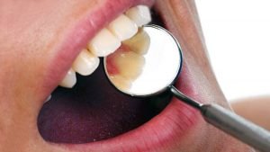 Empastes dentales curan dientes con células madre