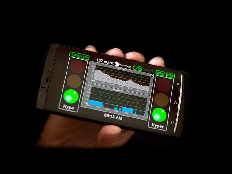 Páncreas artificial estaría disponible en dos años