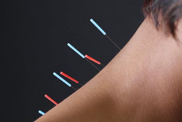 La acupuntura ayuda preservar la memoria