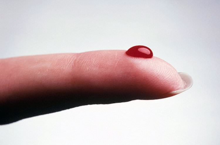 Coágulos de sangre – trombosis - el asesino ignorado