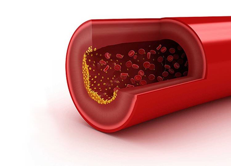 Medicamento para el colesterol limpia las arterias