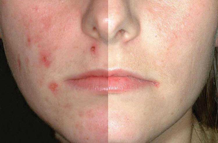 Cicatrices de la espinilla y rejuvenecimiento facial