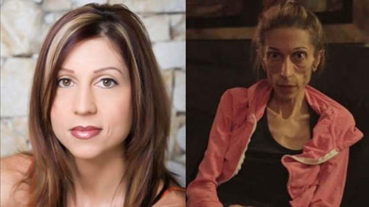 Mujer con anorexia severa gana derecho a morir