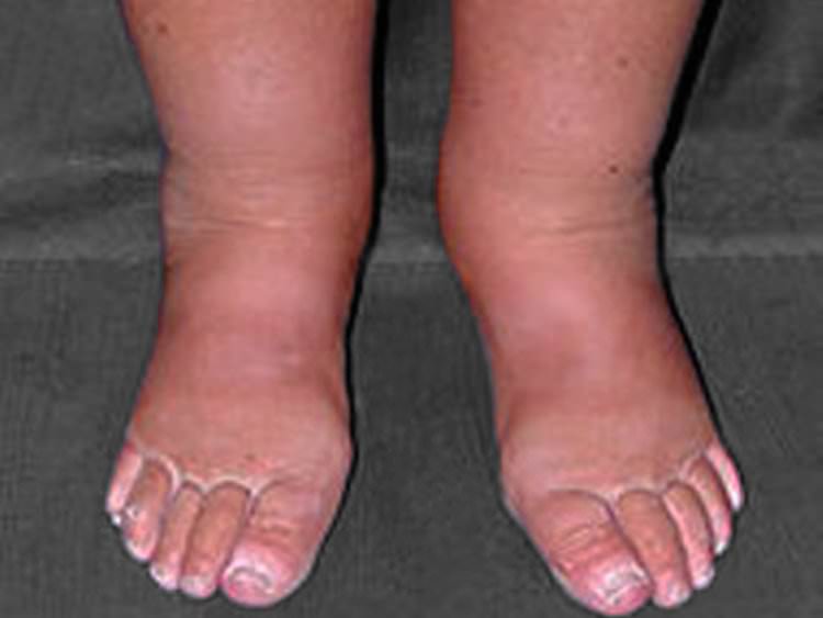 Qué causa el linfedema en piernas y brazos?