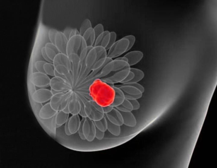 Examen podrá detectar la metástasis del cáncer