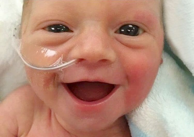 Sonrisa de un bebé después de cirugía de corazón