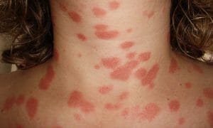 Causas de la Psoriasis - definición - características - tipos - Tratamiento