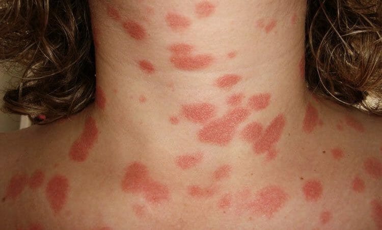 Causas de la Psoriasis - definición - características - tipos - Tratamiento