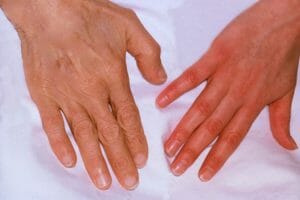 Anemia por falta de hierro – Una causa no detectada