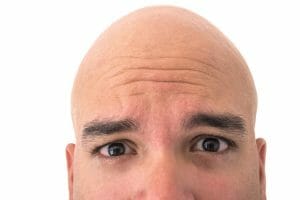 Cura para la Calvicie: ingrediente de la patata de McDonald puede ser la clave