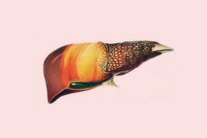 Grasa en el hígado ¿El alcohol es siempre la causa?