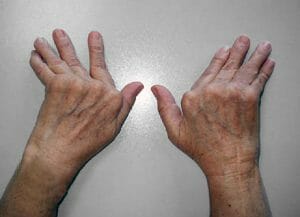 Qué es la artritis - La artritis inflamatoria afecta partes del cuerpo que no imagina