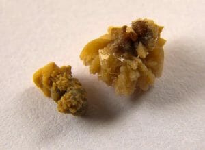 Cálculos renales: causas, síntomas y tratamientos