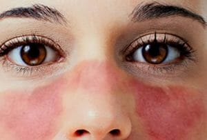 Qué es Lupus - síntomas - ¿Qué lo provoca? - tipos - ¿Es contagioso?